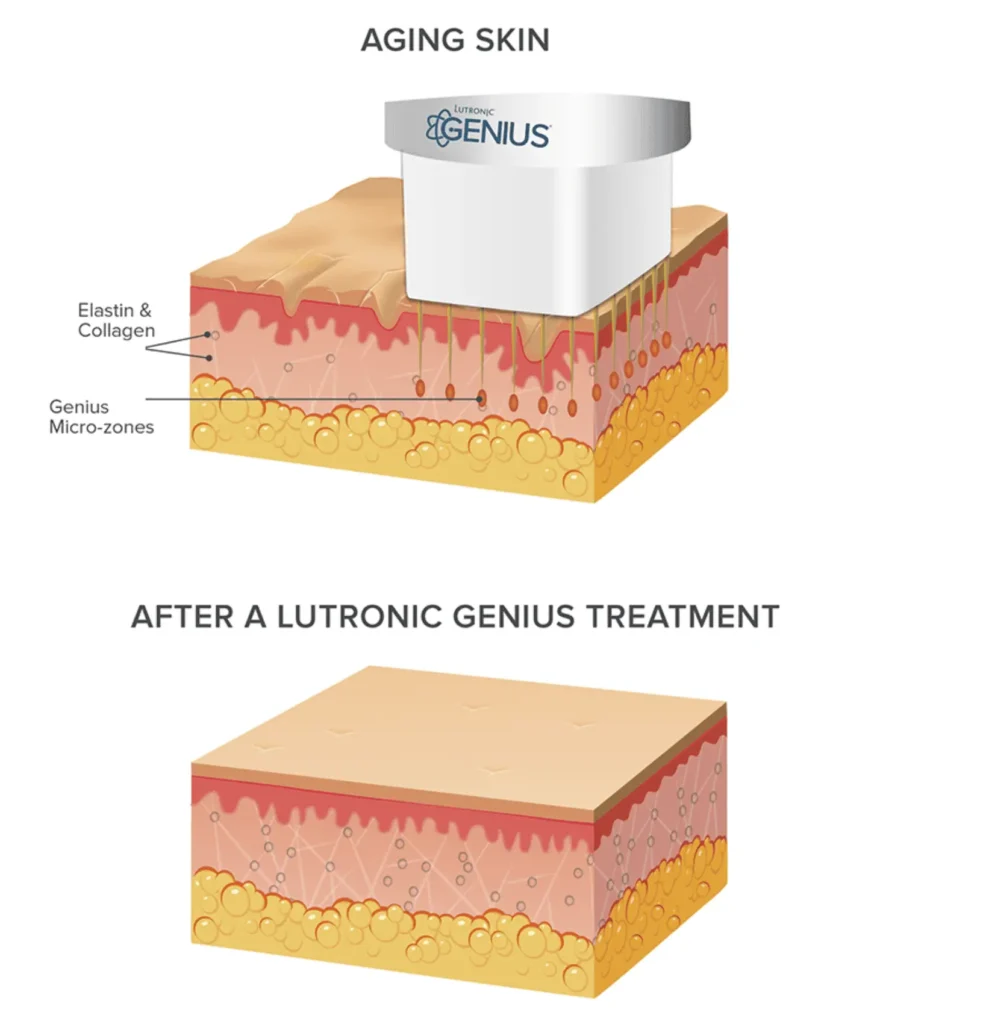 a diagram of aging skin and after Lutronic Genis Treatment | Aesthetify | Watchung, NJ | New York, NY