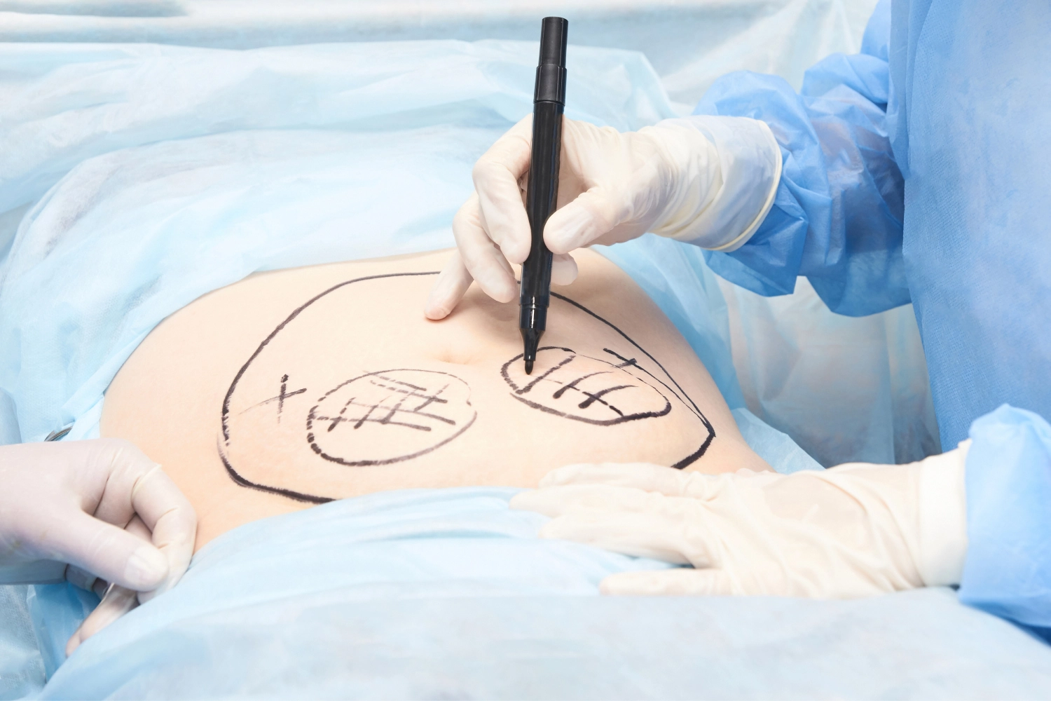 Autologous Fat Transfer | Aesthetify | Watchung, NJ | New York, NY