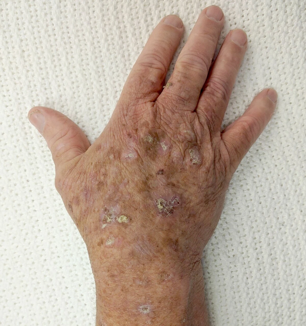 Actinic keratosis | Aesthetify | Watchung, NJ | New York, NY